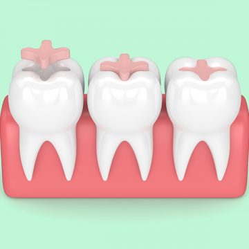 Benefits of Tooth-Colored Dental Fillings