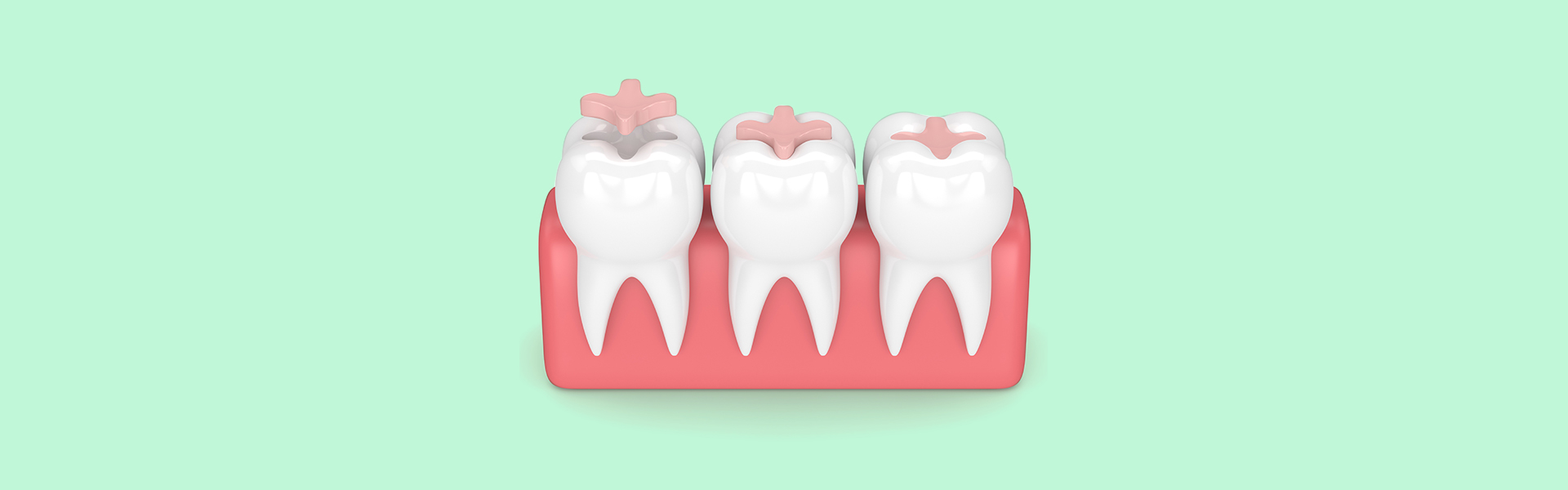 Benefits of Tooth-Colored Dental Fillings 